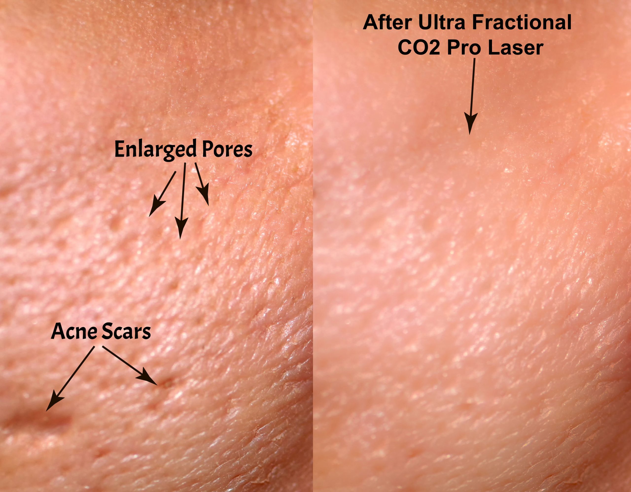 Ultra Fractional CO2 Pro Laser